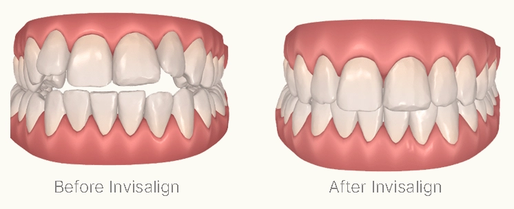 Travel Tips for Anyone Wearing Invisalign Aligners